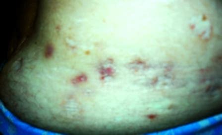 Hidradenitis suppurativa (Verneuil’s disease) .